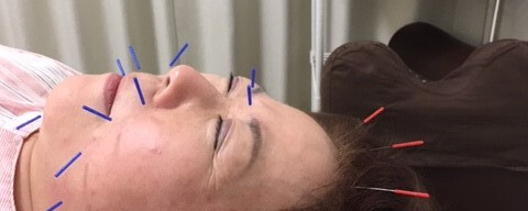 美容鍼