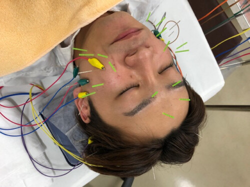 美容鍼・育毛鍼